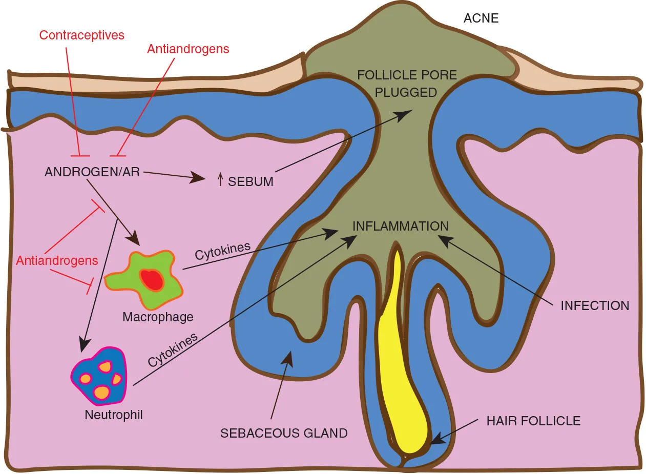 Acne formation process, showing androgenic effects of rad140 on sebum production and inflammation in follicle, affecting macrophages