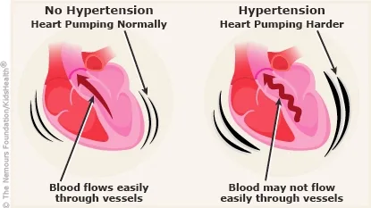 Comparison of normal heart function versus hypertension; blood flow ease shown in vessels; heart pumping harder with