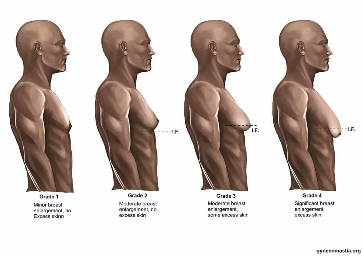 SARMs gynecomastia stages illustration showing varying breast enlargement degrees and skin excess in four grades.